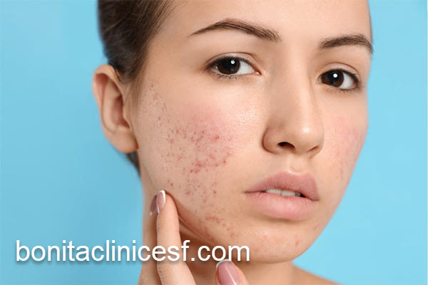 بهترین درمان جای جوش و اسکار در اصفهان | کلینیک بنیتا اصفهان