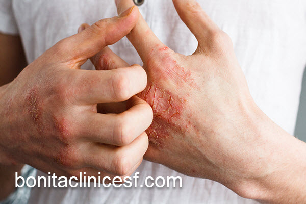 درمان قارچ پوستی در کلینیک معتبر | کلینیک بنیتا اصفهان