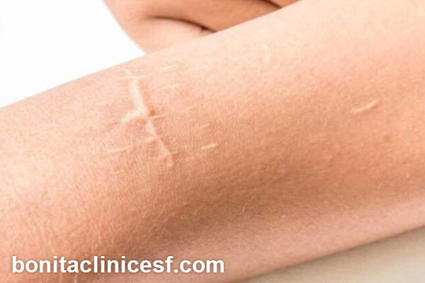 چگونه بهترین مراکز درمان اسکار زخم در اصفهان را پیدا کنیم؟ | کلینیک بنیتا