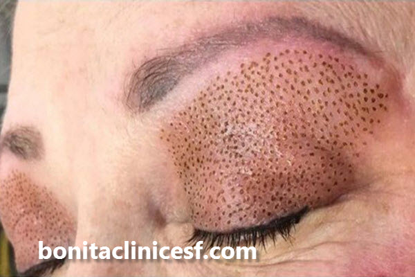 بلفاروپلاستی با لیزر چیست؟ | اصفهان