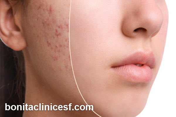 لیزر فرکشنال چگونه موجب درمان جوش های فعال می شود؟ | کلینیک بنیتا اصفهان