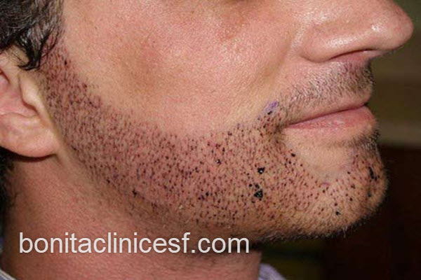 پیوند ریش چقدر زمان می برد؟ | کلینیک بنیتا اصفهان