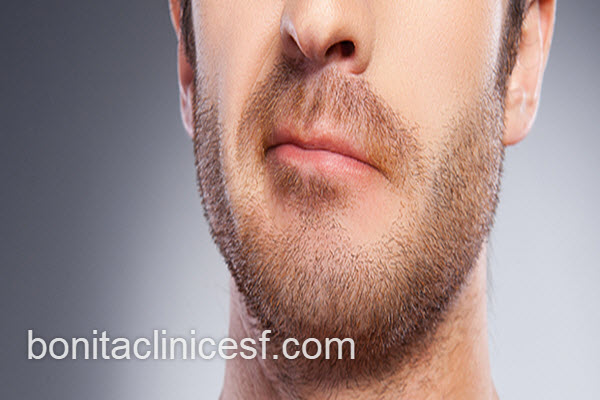 مدت زمان انجام کاشت ریش | کلینیک بنیتا اصفهان