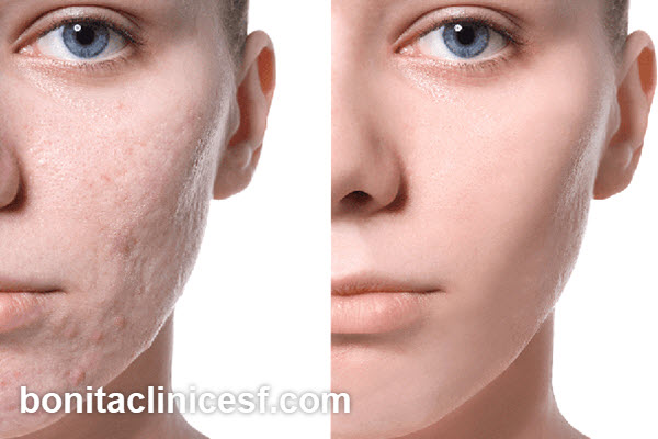 هزینه لیزر جای جوش چقدر است؟ | کلینیک بنیتا اصفهان