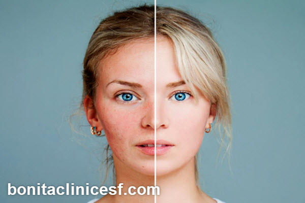 بهترین مرکز برای درمان اسکار در اصفهان | کلینیک بنیتا