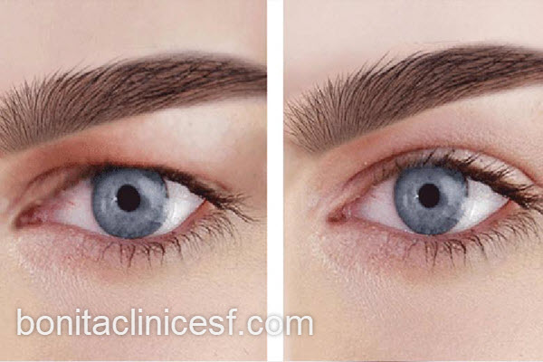 بهترین روش برای درمان افتادگی پلک | کلینیک بنیتا اصفهان