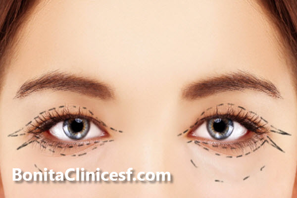 جراحی بلفاروپلاستی چیست؟