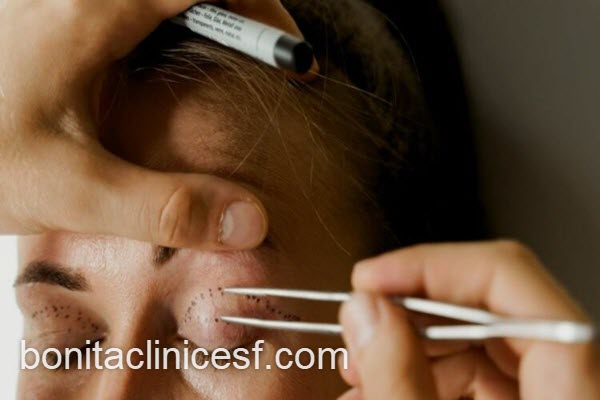 درمان افتادگی پلک با جدیدترین روش | کلینیک بنیتا اصفهان