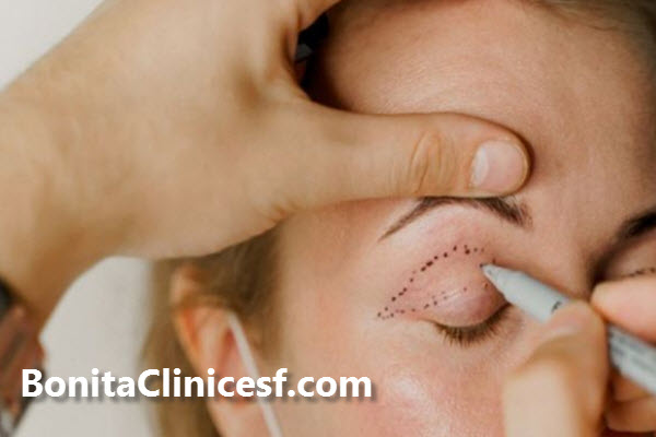 بهترین جراح پلک در اصفهان