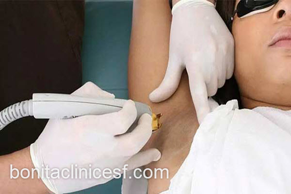 رفع موهای زائد زیر بغل بدون عوارض | کلینیک بنیتا اصفهان