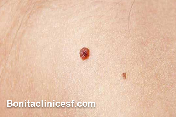 انواع روش های برداشتن خال گوشتی