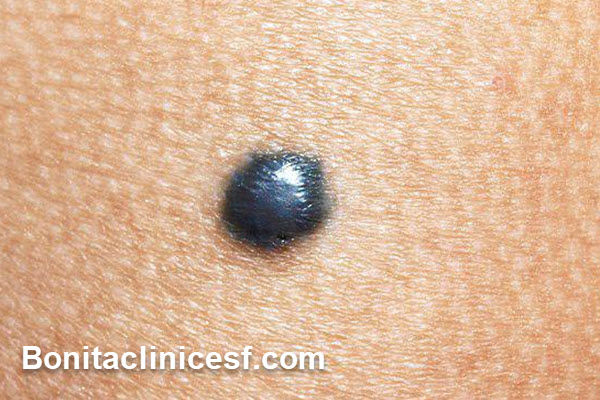 خال گوشتی چیست؟ | اصفهان