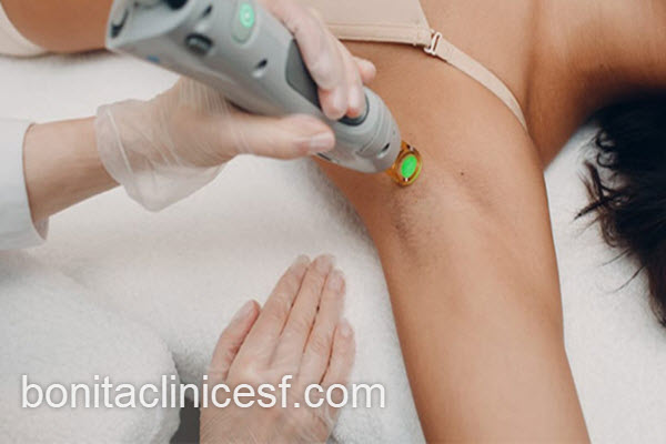 لیزر موهای زائد زیر بغل با بهترین دستگاه | کلینیک بنیتا اصفهان