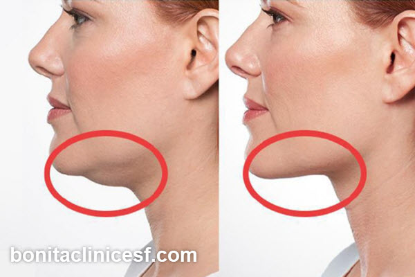 هایفوتراپی غبغب در اصفهان