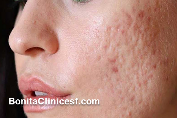 آیا فیشیال برای جای جوش صورت خوب است؟