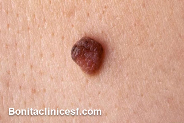 بهترین کلینیک برداشتن خال گوشتی در اصفهان