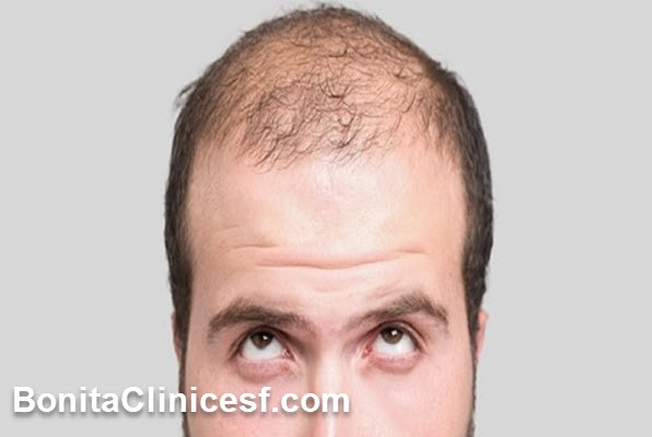 چه مدت بعد از کاشت مو موها میریزد؟