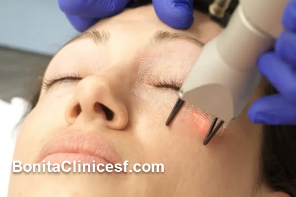 آشنایی با تکنولوژی لیزر RF