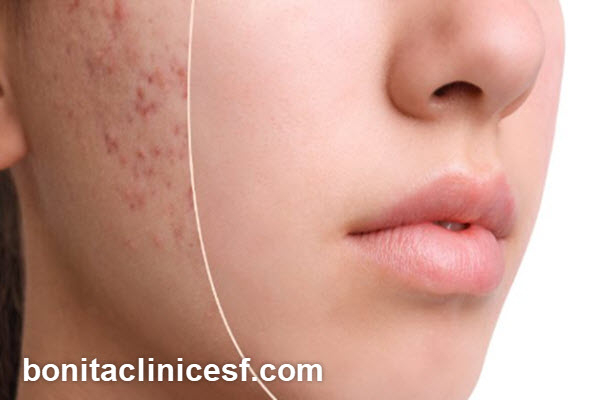 روش های درمان جوش و اسکار در کلینیک های تخصصی