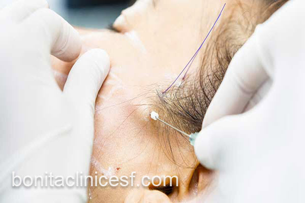 لیفت صورت با نخ با بهترین ماندگاری | کلینیک بنیتا اصفهان