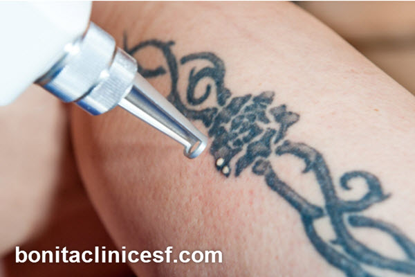 عوامل موثر بر هزینه لیزر کیوسوئیچ