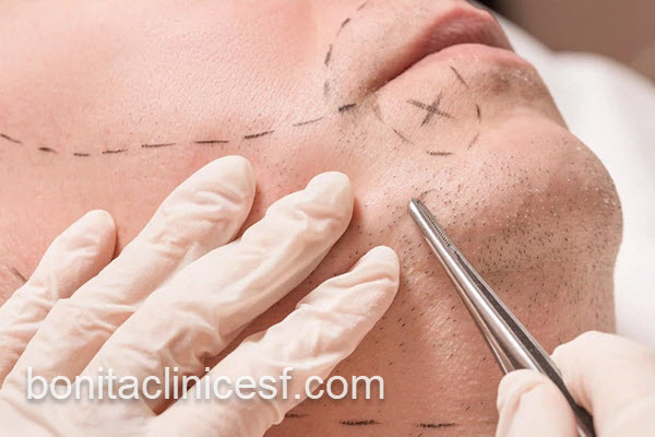 کاشت طبیعی ریش و سبیل | کلینیک بنیتا اصفهان