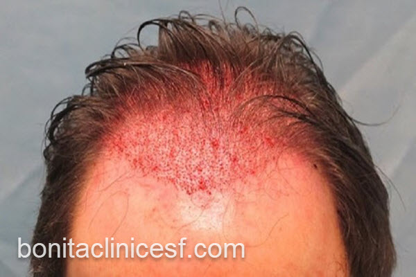 کاشت مو طبیعی در کلینیک تخصصی | کلینیک بنیتا اصفهان