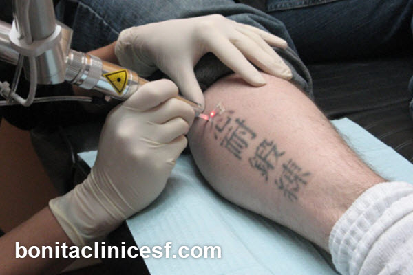 هزینه لیزر کیوسوئیچ در اصفهان سال 1404