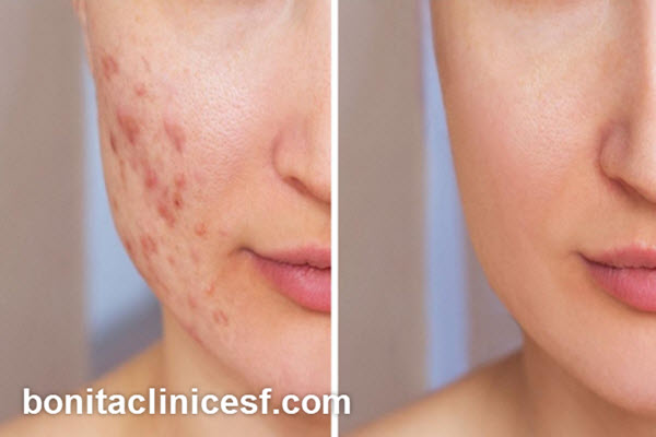 بهترین مرکز درمان جوش و اسکار در اصفهان