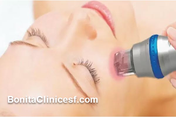 جوانسازی و رفع چین و چروک با لیزر RF