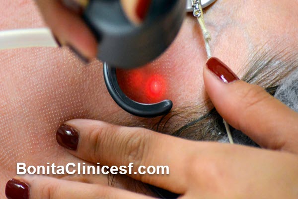 هزینه لیزر فرکشنال co2 چقدر است؟