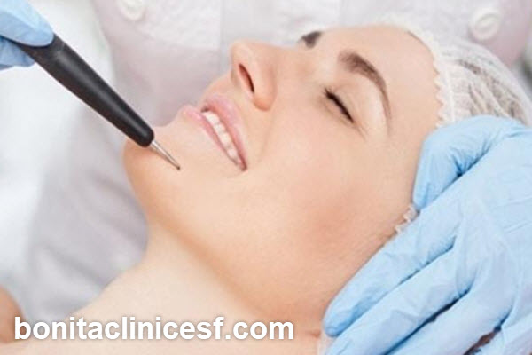 روش لیزر برای حذف خال