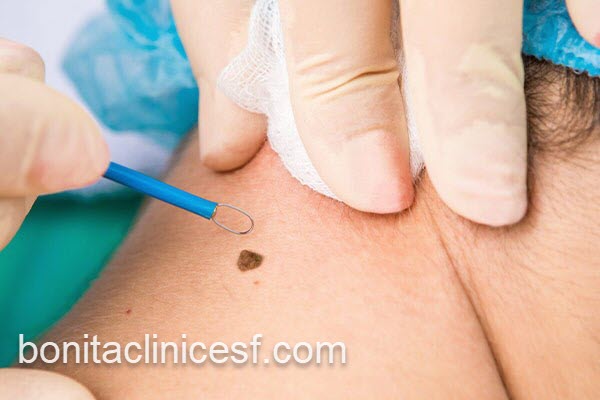 قیمت برداشتن خال در سال 1404 | کلینیک بنیتا اصفهان