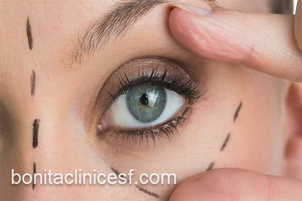 هزینه و قیمت عمل بلفارو | کلینیک بنیتا اصفهان