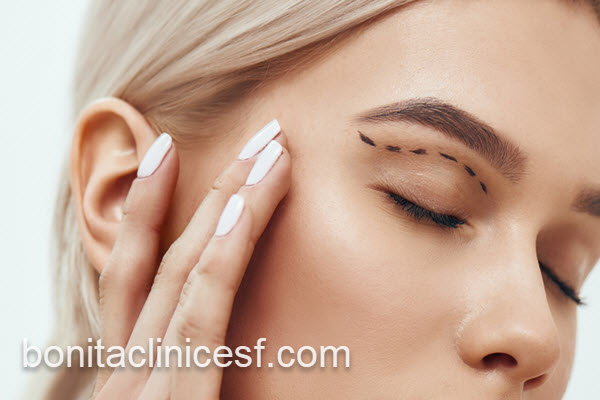 عمل بلفاروپلاستی با هزینه مناسب | کلینیک بنیتا اصفهان