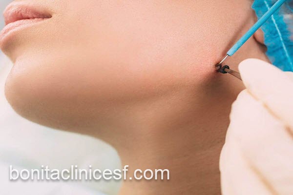 برداشتن خال در اصفهان با قیمت مناسب | کلینیک بنیتا اصفهان