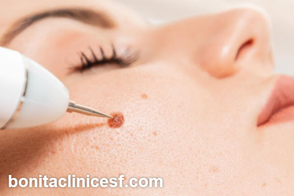 مرکز برداشتن خال در اصفهان