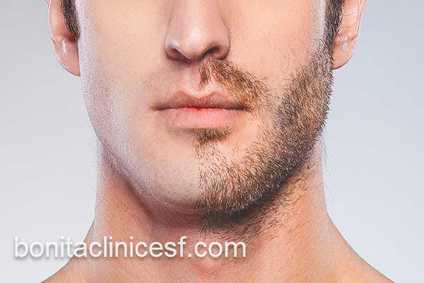 بهترین مرکز کاشت ریش و سبیل در اصفهان | کلینیک بنیتا اصفهان