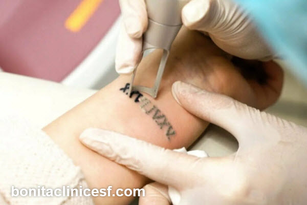 رعایت مراقبت های بعد از لیزر کیوسوئیچ