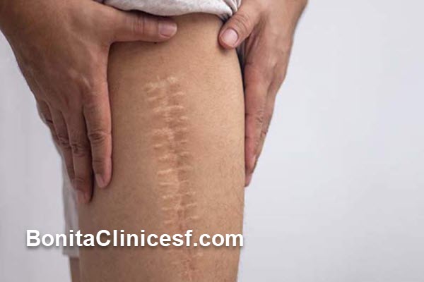 لیزر جای بخیه چگونه عمل میکند؟