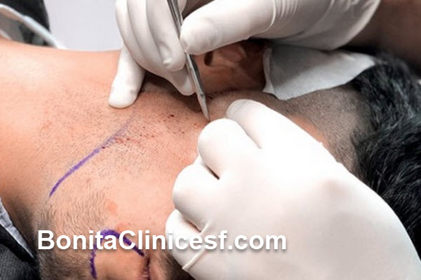 مراقبت های بعد از کاشت ریش و سبیل