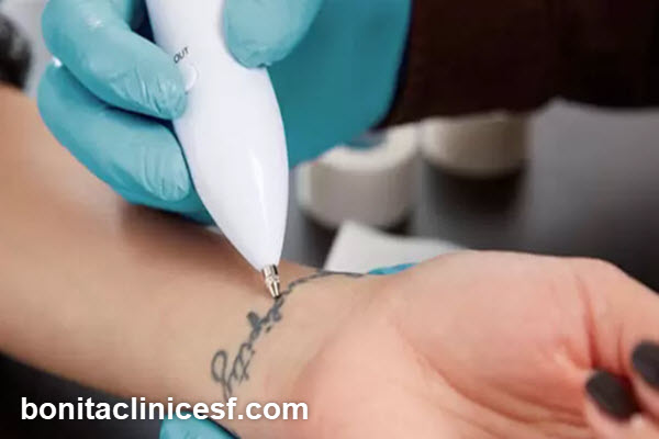 نکات کلیدی در مراقبت های بعد از لیزر کیوسوئیچ