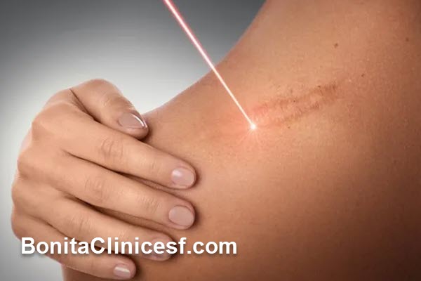 بهترین مرکز لیزر جای بخیه در اصفهان