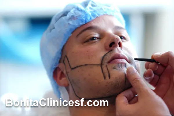 کاشت ریش و سبیل در اصفهان