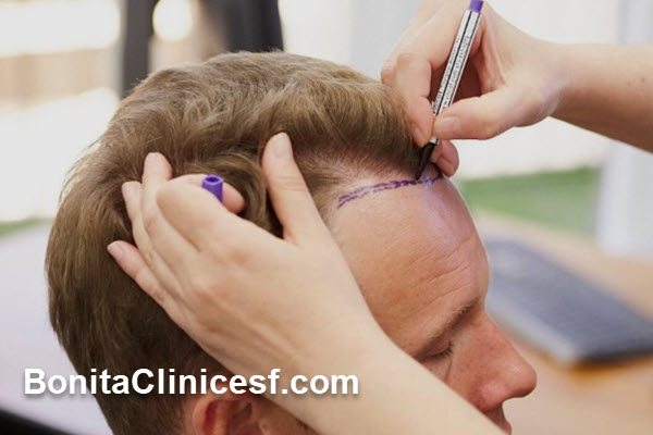 بهترین کلینیک کاشت مو در اصفهان