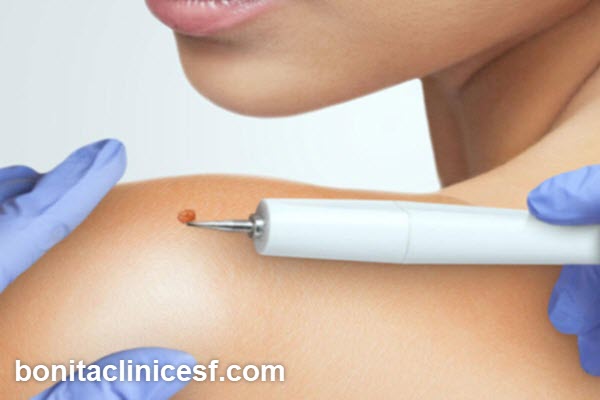 روش های برداشتن خال