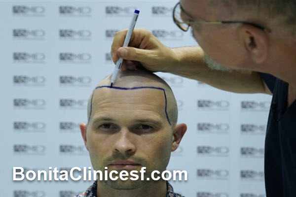 ریزش مو چرا اتفاق می افتد؟