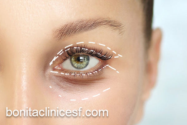 نکات مهم بعد از عمل جراحی بلفاروپلاستی