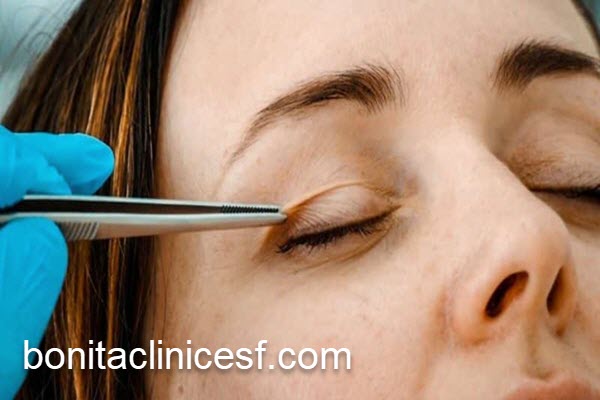 عمل بلفاروپلاستی و جنبه زیبایی آن