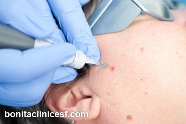 هزینه برداشتن خال در کلینیک های مختلف